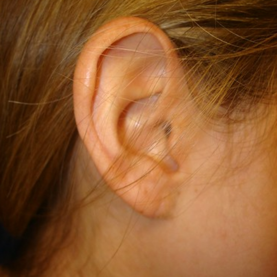 耳垂修复拉伸或分裂穿孔